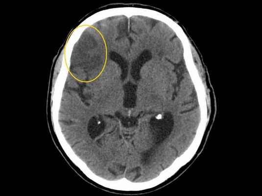 Доза облучения при КТ
