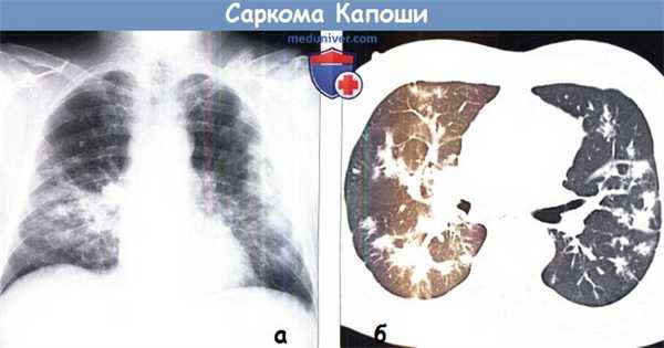 Саркома Капоши на рентгенограмме и КТ