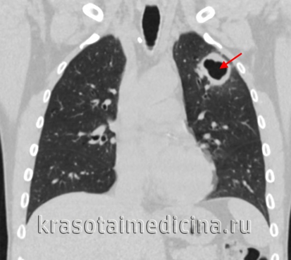 Туберкулез кишечника