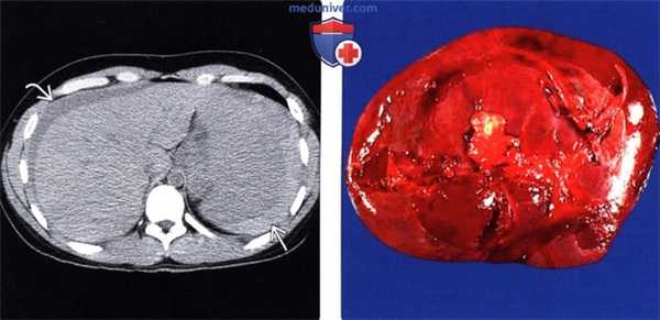 Лучевые изменения брюшной полости при мононуклеозе