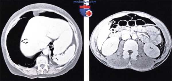 Лучевые изменения брюшной полости при баротравме
