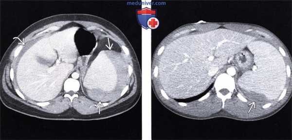 Лучевые изменения брюшной полости при мононуклеозе