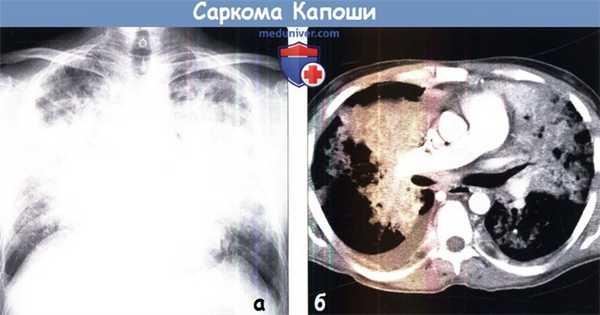 Саркома Капоши на рентгенограмме и КТ