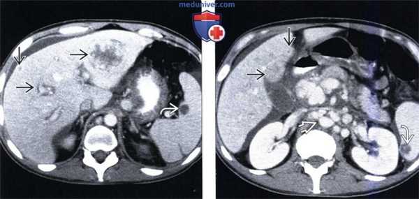 КТ, МРТ, УЗИ признаки пелиоза печени