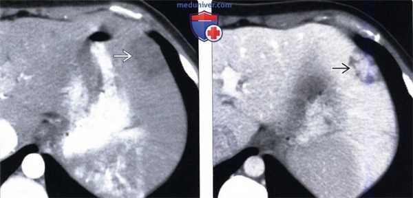 КТ, МРТ, УЗИ признаки пелиоза печени