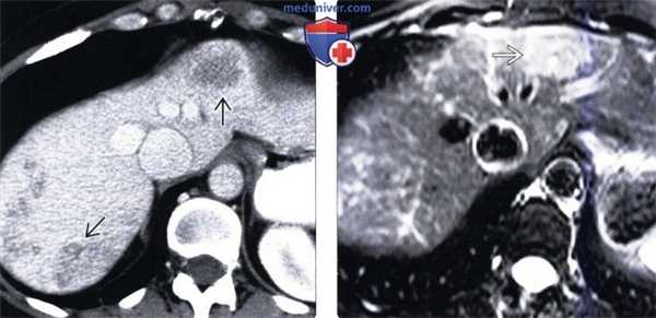 КТ, МРТ, УЗИ признаки пелиоза печени