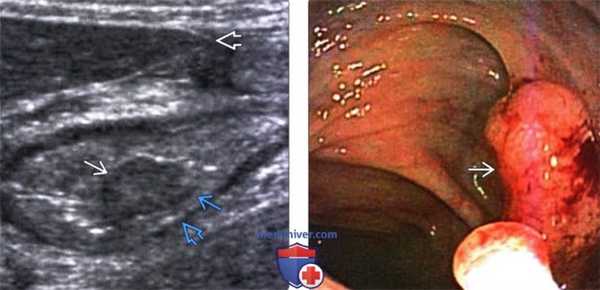 УЗИ при опухоли толстой кишки