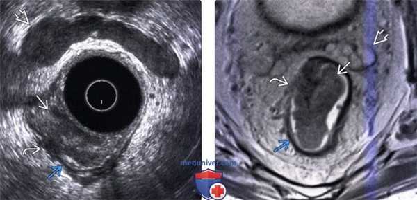 УЗИ при опухоли толстой кишки