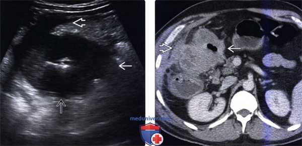 УЗИ при опухоли толстой кишки