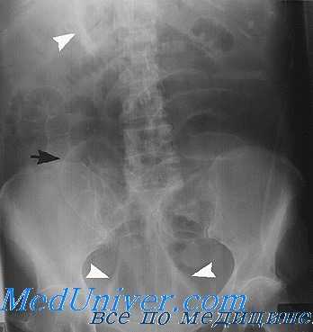 рентгенография органов брюшной полости