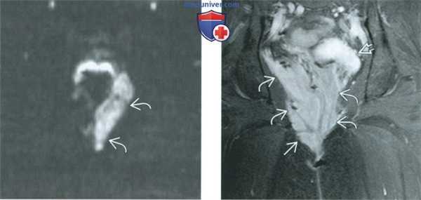 КТ, МРТ, УЗИ при агрессивной ангиомиксоме вульвы и влагалища