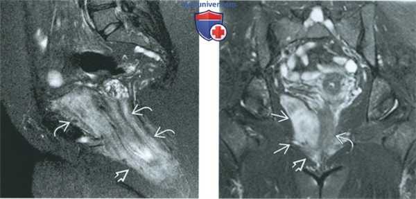 КТ, МРТ, УЗИ при агрессивной ангиомиксоме вульвы и влагалища