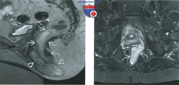КТ, МРТ, УЗИ при агрессивной ангиомиксоме вульвы и влагалища