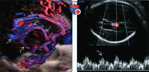 УЗИ, МРТ при аневризме вены Галена (АВГ) у плода