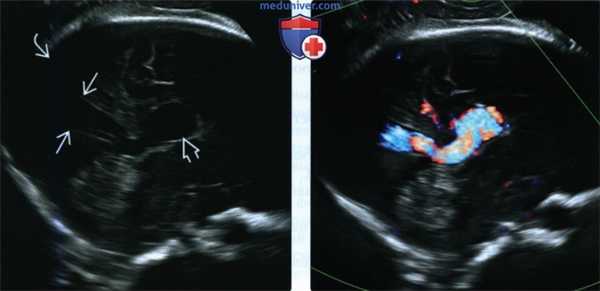 УЗИ, МРТ при аневризме вены Галена (АВГ) у плода