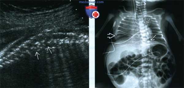 УЗИ при ассоциации VACTERL у плода
