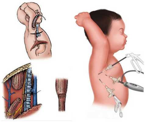 Торакотомия (слева) и торакоскопия (справа)
