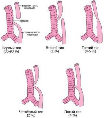 Типы атрезии пищевода