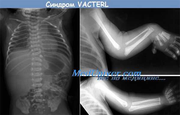 секвенция vater