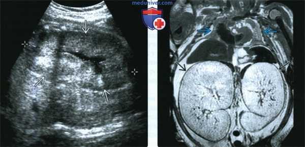 УЗИ, МРТ при аутосомно-рецессивном поликистозе почек у плода