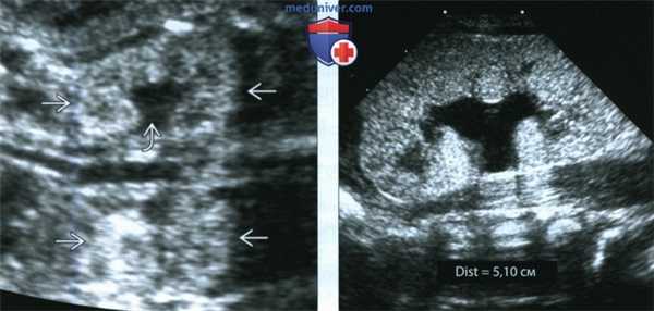 УЗИ, МРТ при аутосомно-рецессивном поликистозе почек у плода