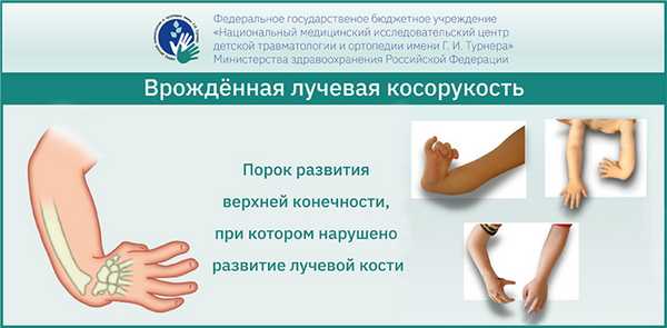 Врождённая лучевая косорукость - консервативное и хирургическое лечение