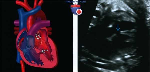 Лучевые признаки дефекта межжелудочковой перегородки (ДМЖП) сердца плода