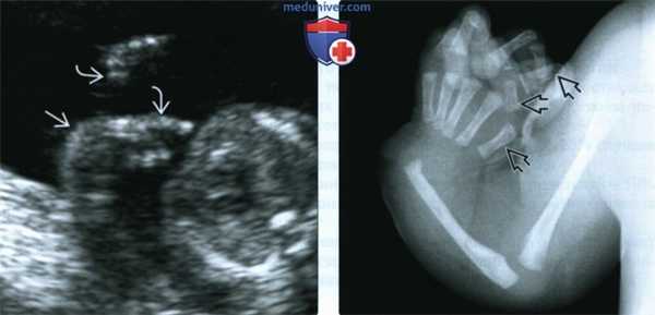 УЗИ при дефекте радиального луча у плода
