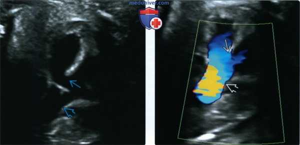 Лучевые признаки дефекта межжелудочковой перегородки (ДМЖП) сердца плода