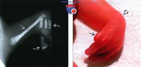 УЗИ при дефекте радиального луча у плода
