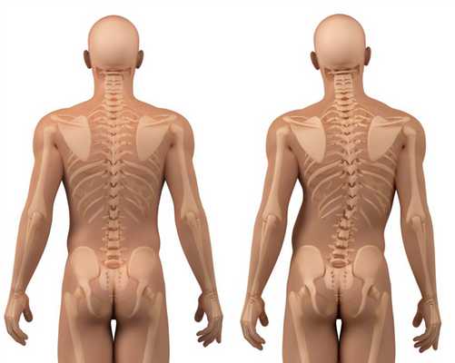 Сколиоз при метафизарной дисплазии