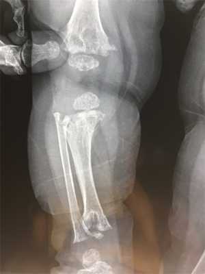 Метафизарная дисплазия