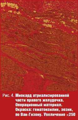 Миокард атриализированной части правого желудочка.