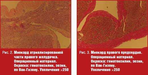 Миокард атриализированной