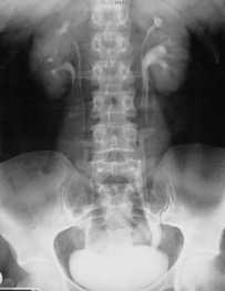 double system on urography