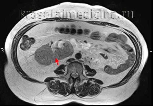 Врожденные аномалии мочеточника