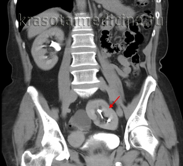 Агенезия почки