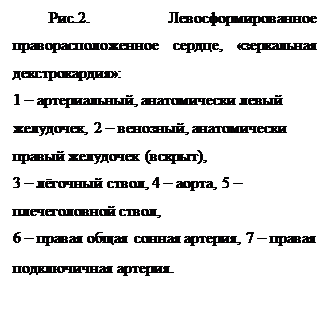 Надпись: Рис.2. Левосформированное праворасположенное сердце, «зеркальная декстрокардия»: 1 – артериальный, анатомически левый желудочек, 2 – венозный, анатомически правый желудочек (вскрыт), 3 – лёгочный ствол, 4 – аорта, 5 – плечеголовной ствол, 6 – правая общая сонная артерия, 7 – правая подключичная артерия.
