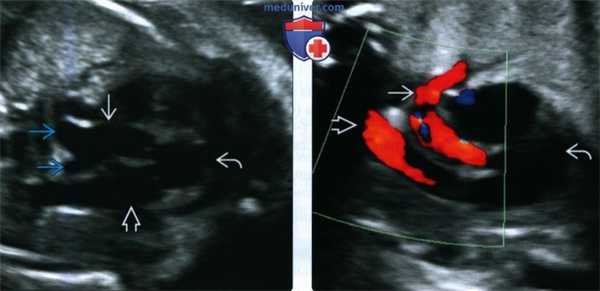 УЗИ, МРТ при гетеротаксическом и кардиоспленическом синдроме у плода