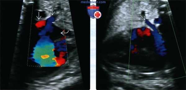 УЗИ, МРТ при гетеротаксическом и кардиоспленическом синдроме у плода