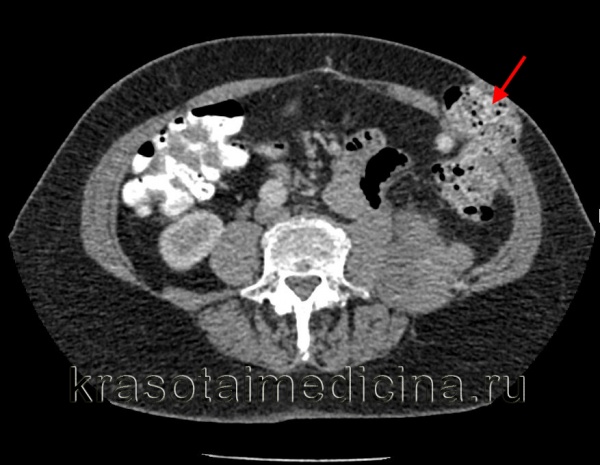 КТ ОБП. Пролабирование петли нисходящей ободочной кишки через боковую стенку живота в подкожную клетчатку.