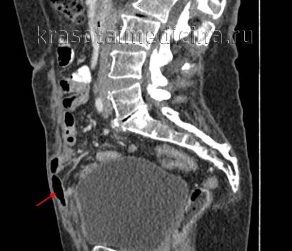 Грыжа белой линии живота