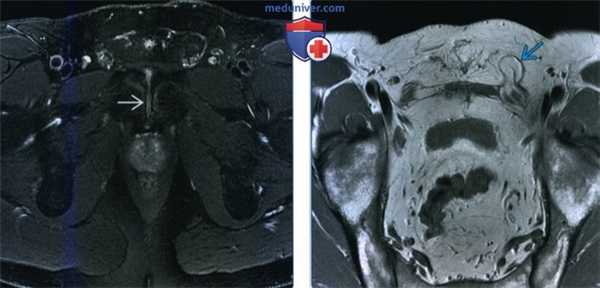 Лучевые признаки грыжи стенки живота