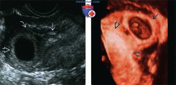 УЗИ, МРТ при интерстициальной трубной беременности