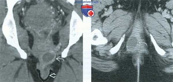 КТ, МРТ, УЗИ при бартолините