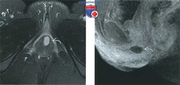 КТ, МРТ, УЗИ при кисте железы Скина