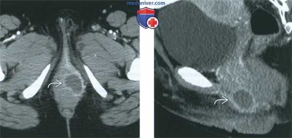 КТ, МРТ, УЗИ при бартолините