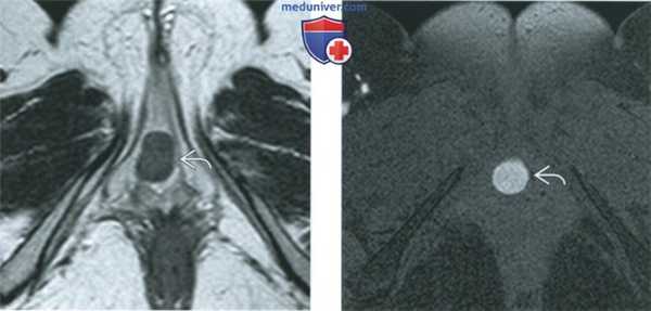 КТ, МРТ, УЗИ при кисте железы Скина