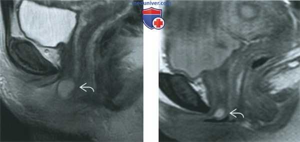КТ, МРТ, УЗИ при кисте железы Скина