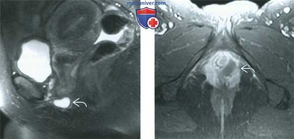 КТ, МРТ, УЗИ при бартолините